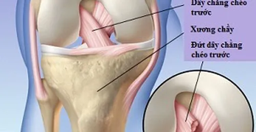 Tổn thương dây chằng chéo trước