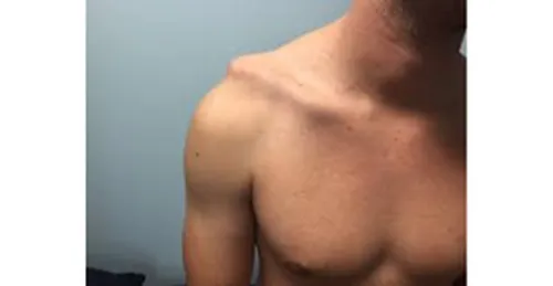 Tổn thương khớp cùng đòn