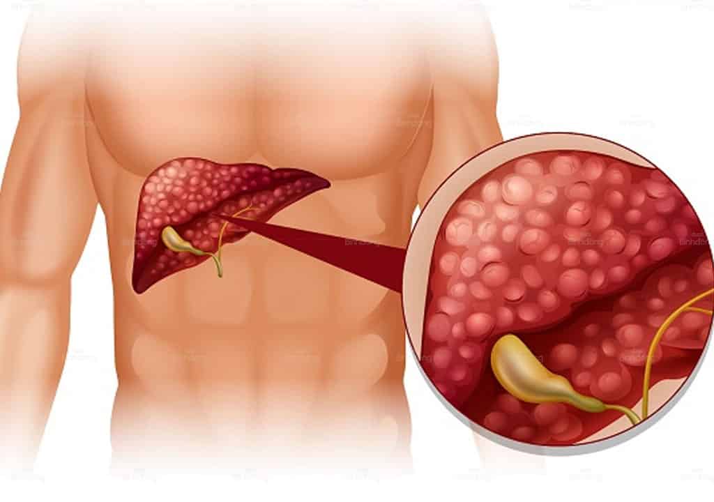 Vì sao phải thải độc gan? Vì sao phải thải độc gan?
