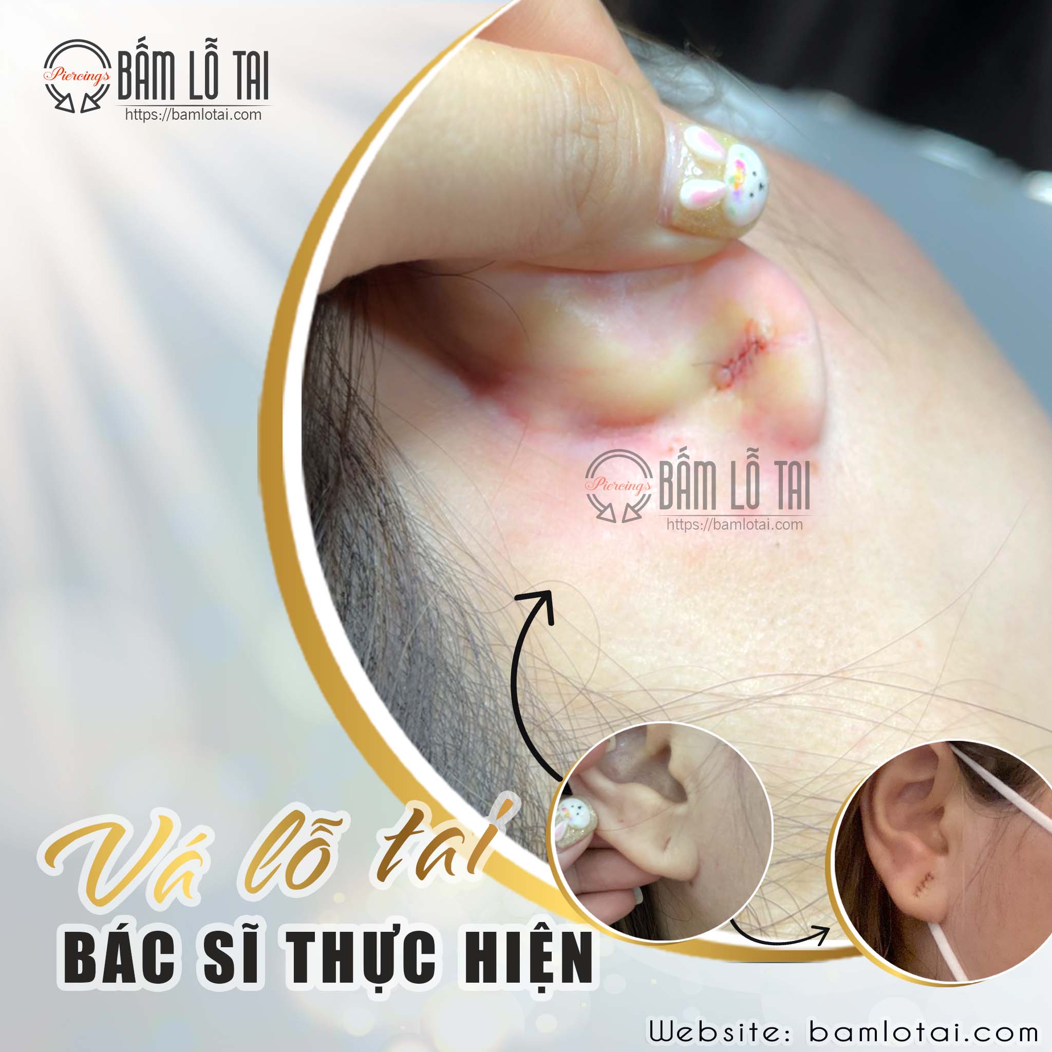vá lỗ tai thẩm mỹ