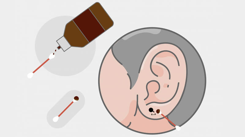 Bôi thuốc gì sau khi bấm lỗ tai