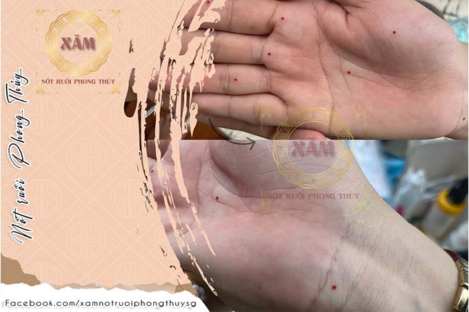 nốt ruồi lòng bàn tay