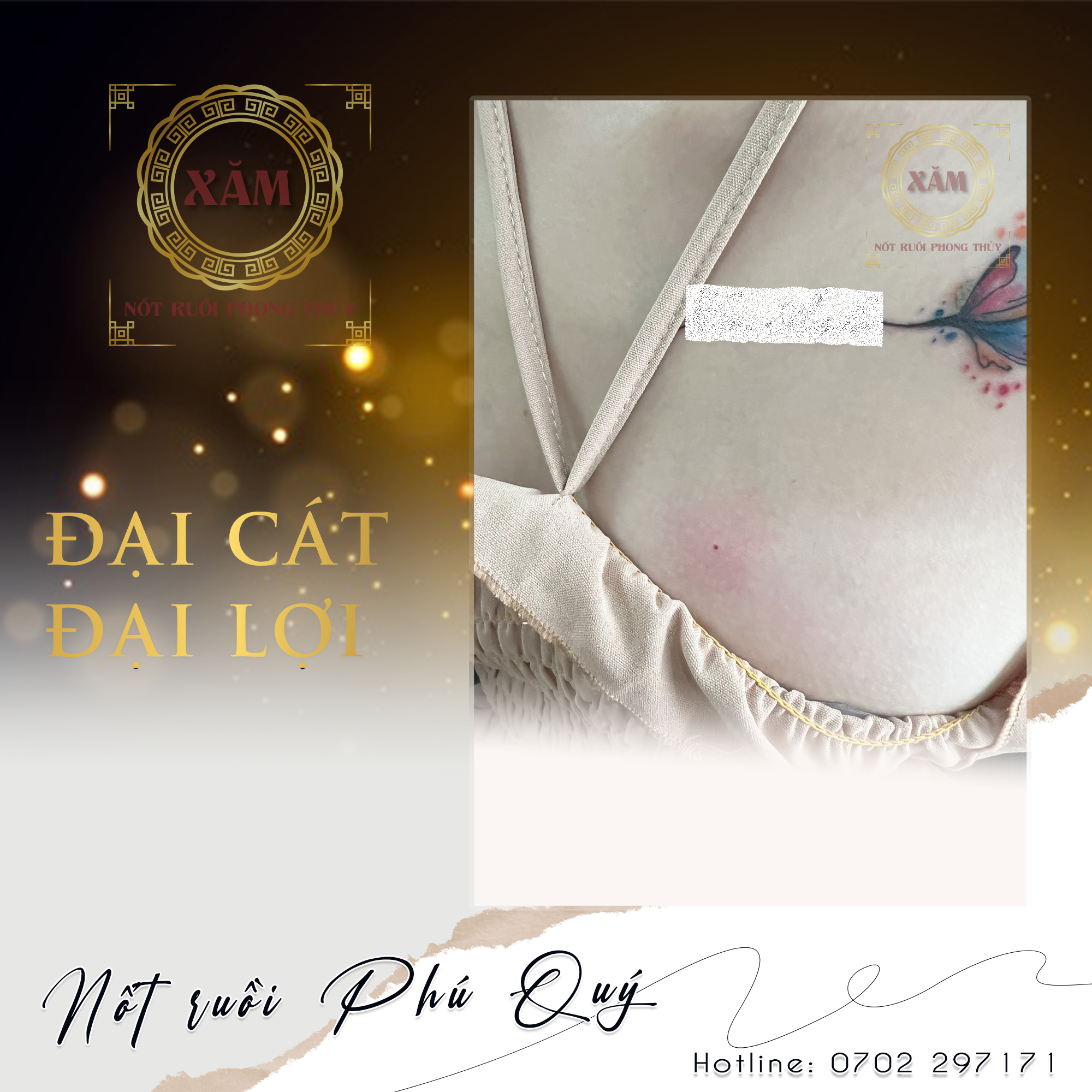 nốt ruồi đại cát
