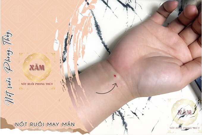nốt ruồi son cổ tay
