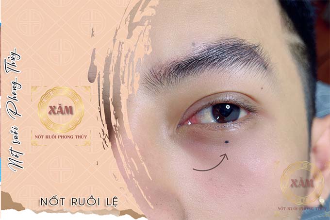nốt ruồi mí mắt