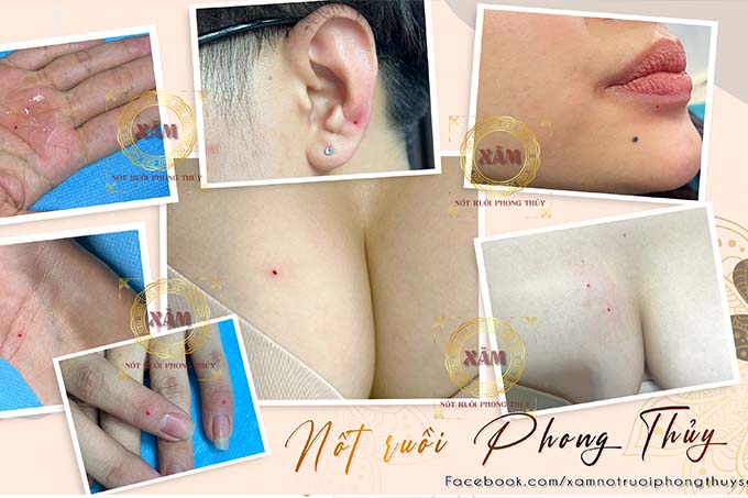 nốt ruồi son phong thủy hcm