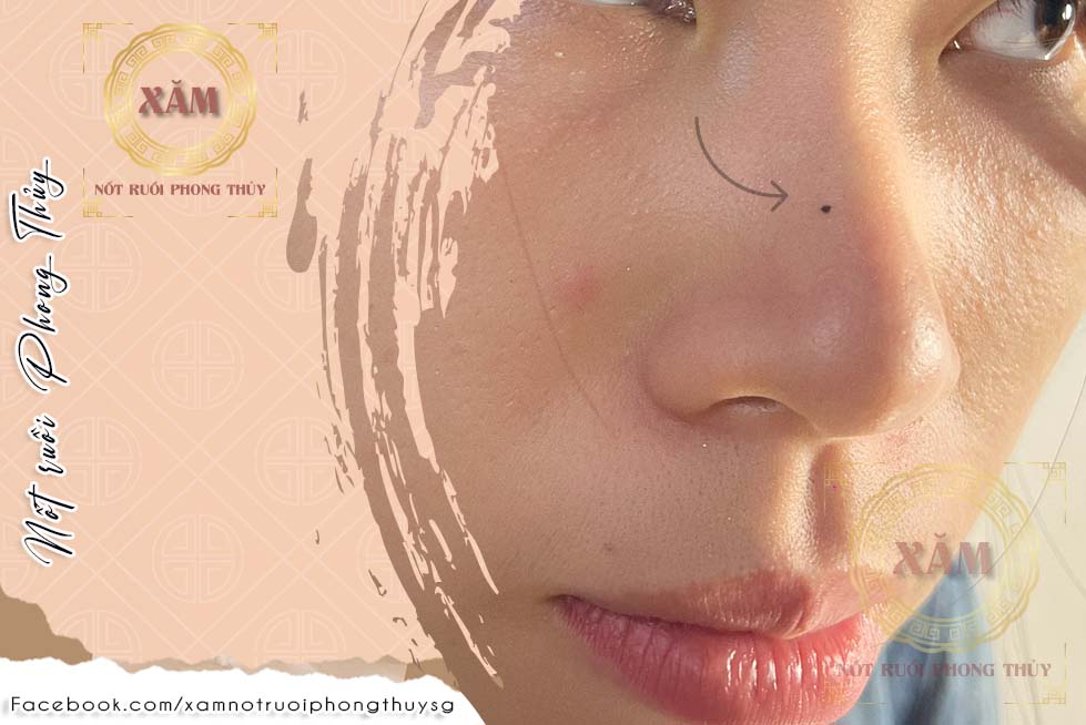 nốt ruồi trên sóng mũi
