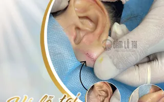 Khắc phục triệt để lỗ tai bị giãn rộng bằng phương pháp Vá lỗ tai