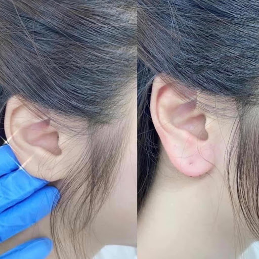 tiêm dái tai tài lộc tiêm dái tai tài lộc