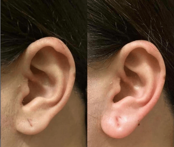 tiêm tai tài lộc