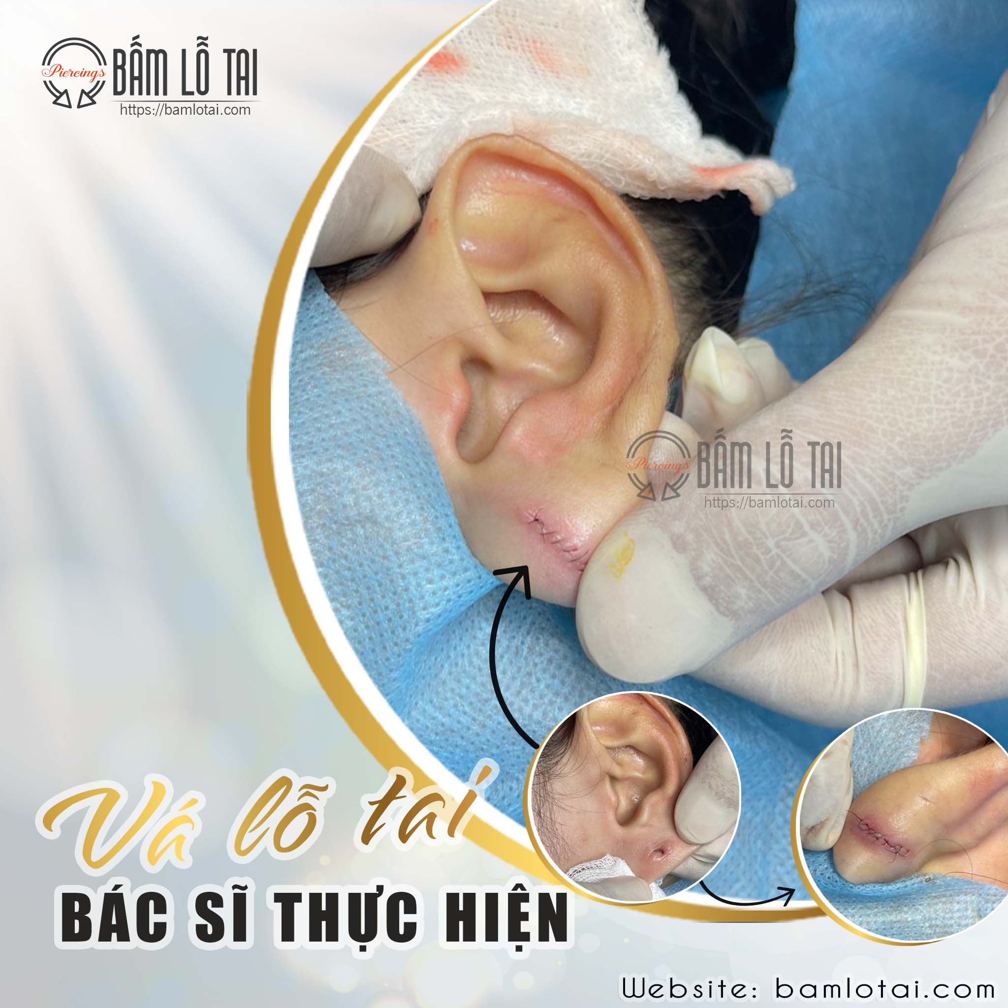 khâu lỗ tai bị rộng khâu lỗ tai bị rộng