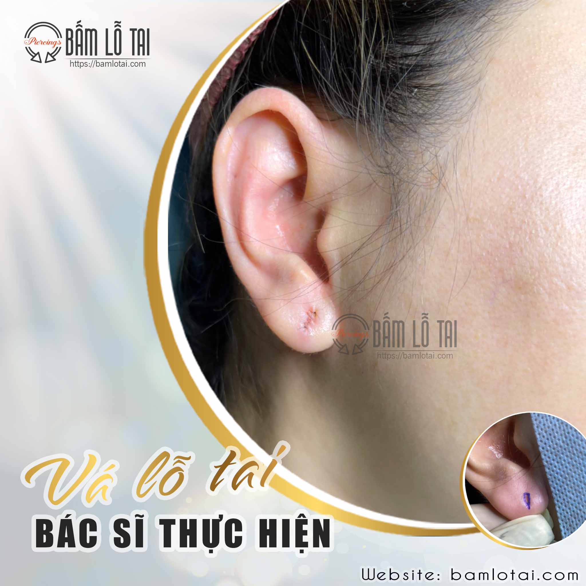 quy trình vá lỗ tai quy trình vá lỗ tai