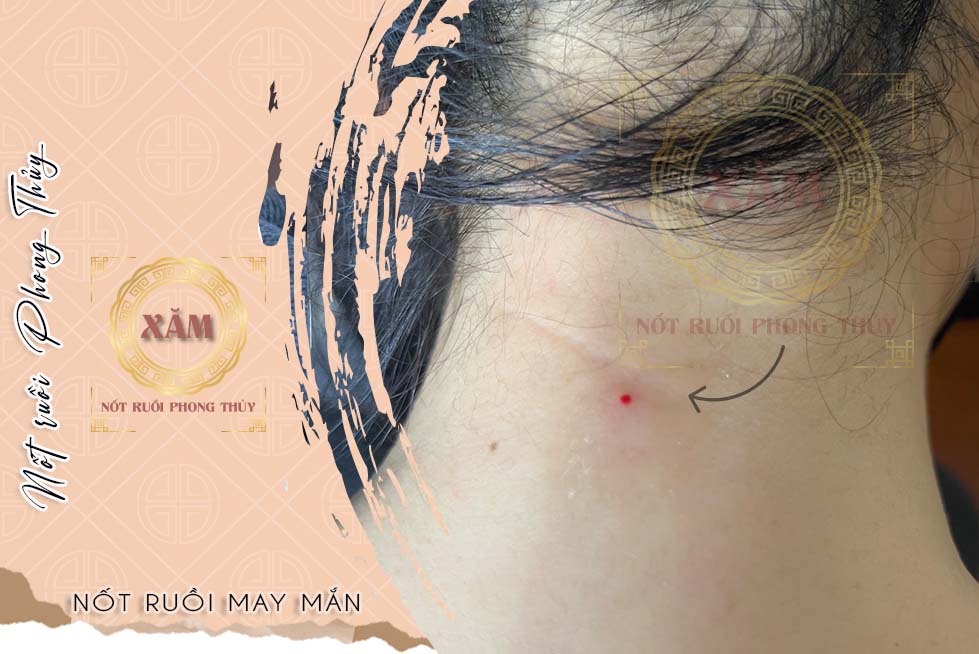 xăm nốt ruồi cổ