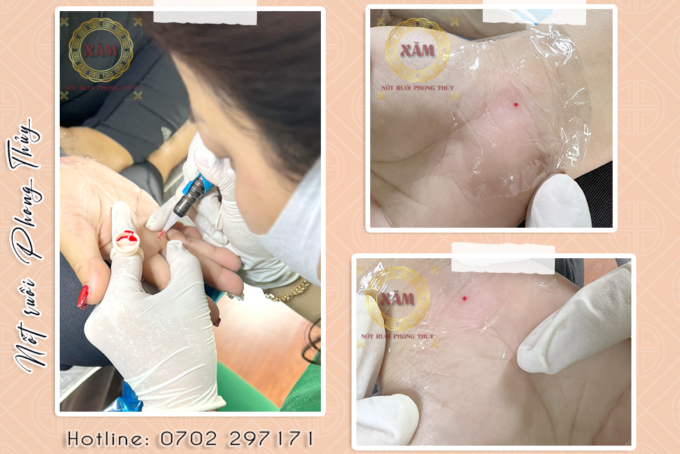 xăm nốt ruồi chuẩn y khoa