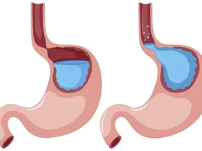 Thực phẩm chức năng dành cho người bị trào ngược dạ dày được tin dùng hiện nay