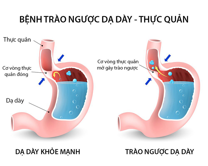 Trào ngược dạ dày có dấu hiệu gì? Trào ngược dạ dày có dấu hiệu gì?