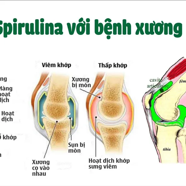 VASTCOM BONJOINT ( Sản phẩm bổ sung Tảo Spirulina cho người bệnh xương khớp)
