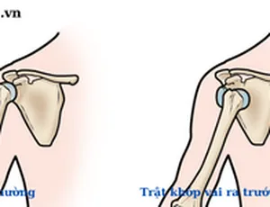MẤT VỮNG KHỚP VAI MÃN TÍNH