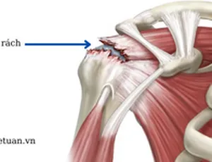 RÁCH GÂN CƠ CHÓP XOAY