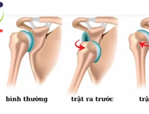 TRẬT KHỚP VAI