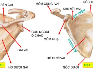 GÃY XƯƠNG BẢ VAI