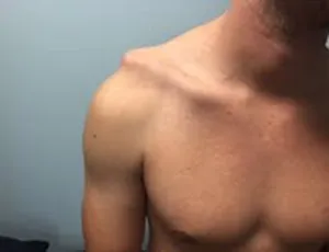 Tổn thương khớp cùng đòn