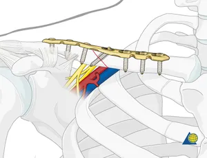 GÃY XƯƠNG ĐÒN (XƯƠNG QUAI XANH)