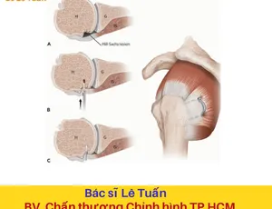 Kỹ thuật Remblissage