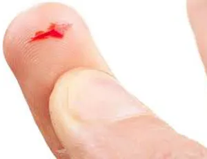 SƠ CỨU VẾT THƯƠNG NGÓN TAY