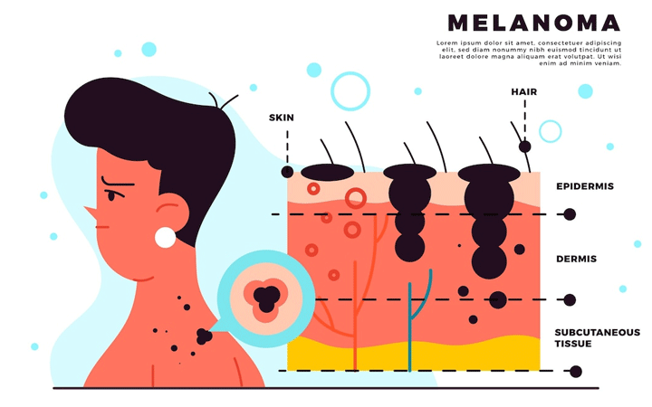 nguyên nhân gây nám tàn nhang