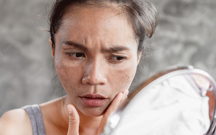 nguy cơ tiềm ẩn của nám da