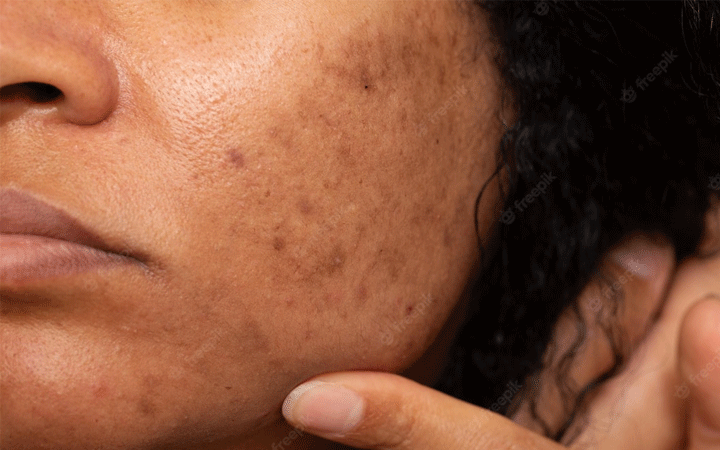 trị nám lâu năm