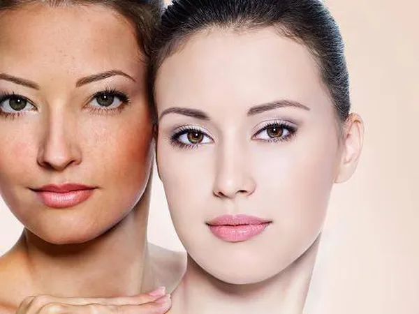 Trị Nám Da Tại Nhà Bằng Sản Phẩm Thảo Dược Cực Kì Đơn Giản