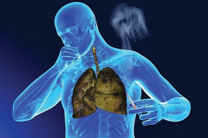 Bệnh ung thư phổi ở nam giới Bệnh ung thư phổi ở nam giới