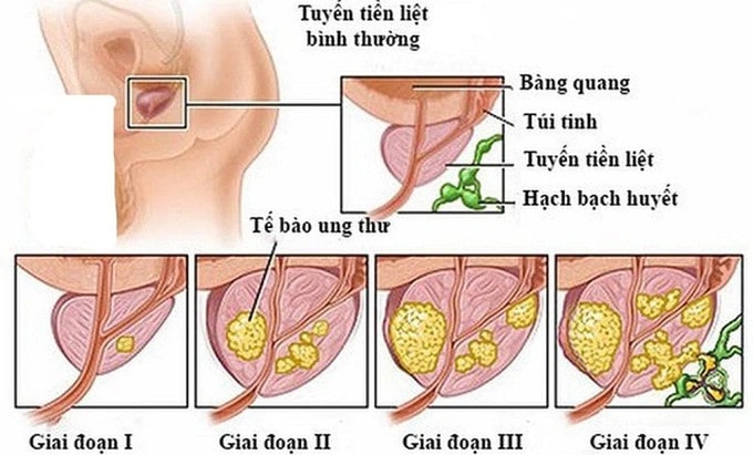 Bệnh ung thư tuyến tiền liệt ở nam giới Bệnh ung thư tuyến tiền liệt ở nam giới
