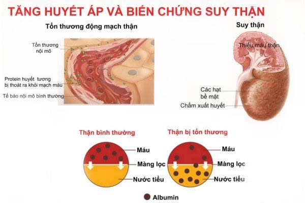 Tăng huyết áp nguyên nhân gây yếu thận Tăng huyết áp nguyên nhân gây yếu thận