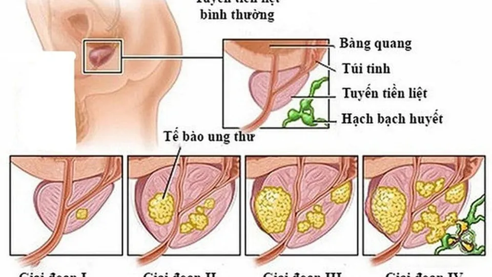 5 bệnh ung thư thường gặp ở nam giới nên biết