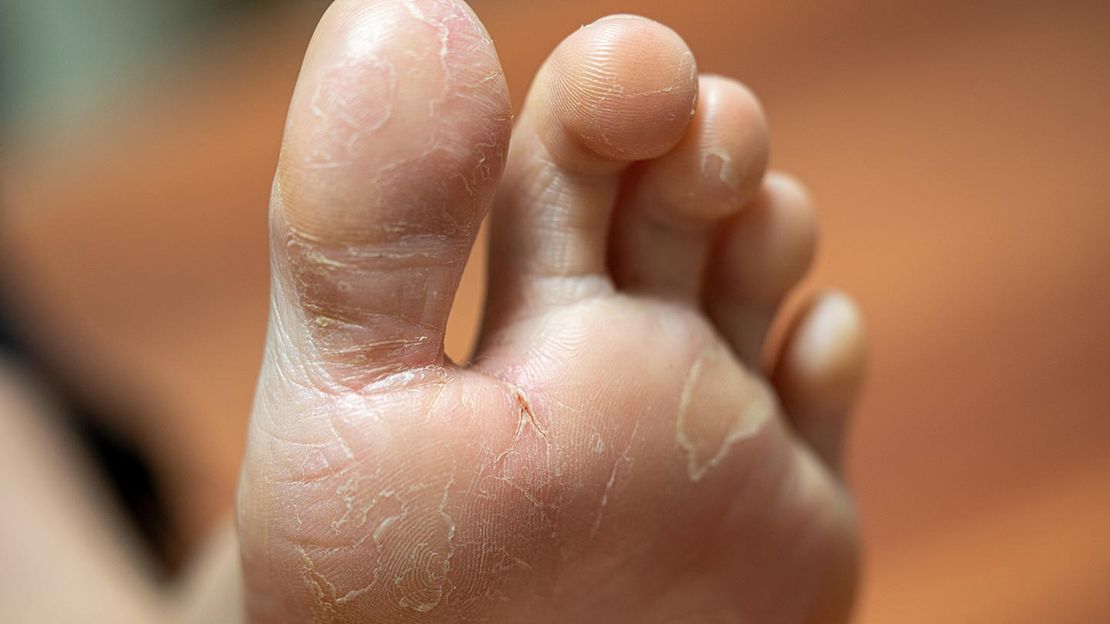 Bệnh vẩy nến ở chân