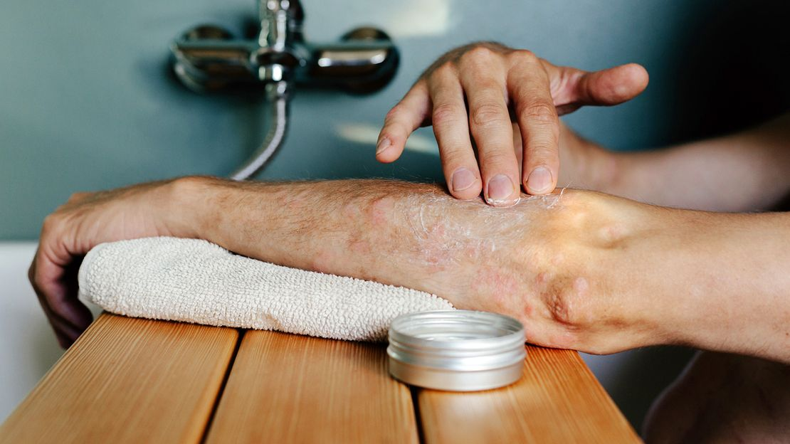 Làm thế nào để loại bỏ vảy nến một cách an toàn