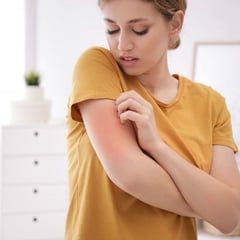Các liệu pháp thay thế và bổ sung cho bệnh viêm da dị ứng