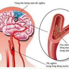 Hiểu các loại đột quỵ khác nhau và triệu chứng để phát hiện kịp thời