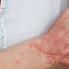 Ngày Thế giới Bệnh vẩy nến: lời khuyên của Phòng thí nghiệm Indemne để giảm khó chịu 