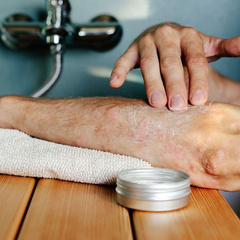 Làm thế nào để loại bỏ vảy nến một cách an toàn