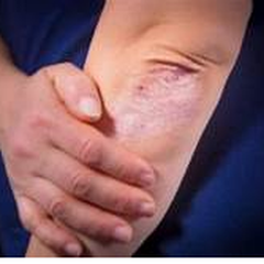 Bệnh viêm khớp vảy nến là gì? Triệu chứng, Nguyên nhân, Chẩn đoán, Điều trị và Phòng ngừa
