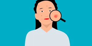 Mụn trứng cá trong giai đoạn dậy thì