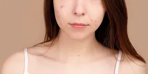 Tất Tần Tật Về Các Loại Mụn Thường Gặp Ở Tuổi Dậy Thì: Nguyên Nhân và Cách Điều Trị