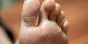 Bệnh vẩy nến ở chân