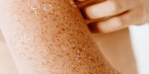 Cách điều chỉnh khi Da bị kích ứng mà không cần dùng Cortisone