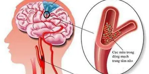 Các loại Đột quỵ,  triệu chứng và phòng chống