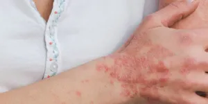 Ngày Thế giới Bệnh vẩy nến: lời khuyên của Phòng thí nghiệm Indemne để giảm khó chịu